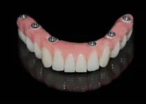 Dentista especialista en implantes ofrece soluciones avanzadas para tu sonrisa