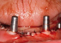 Implantes dentales en situaciones complicadas y cómo manejarlos