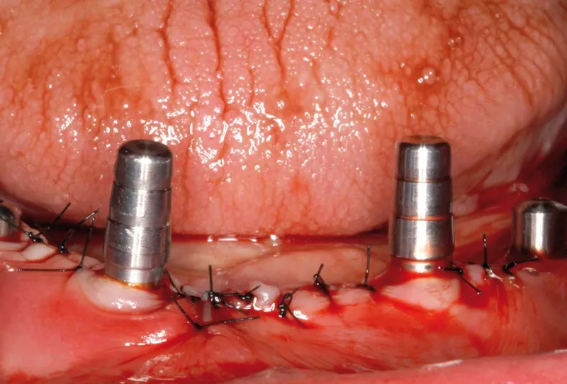 Implantes dentales en situaciones complicadas