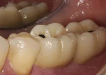 Caries en la encía: entiende sus causas y cómo prevenirlas