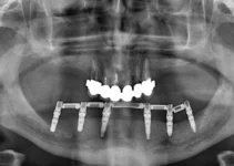 Endodoncia multirradicular precio y factores que influyen en el costo