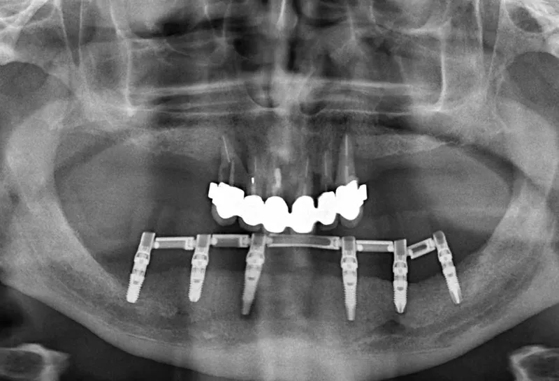 endodoncia multirradicular precio