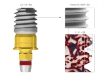 Implantes Klockner y su eficacia en la odontología moderna