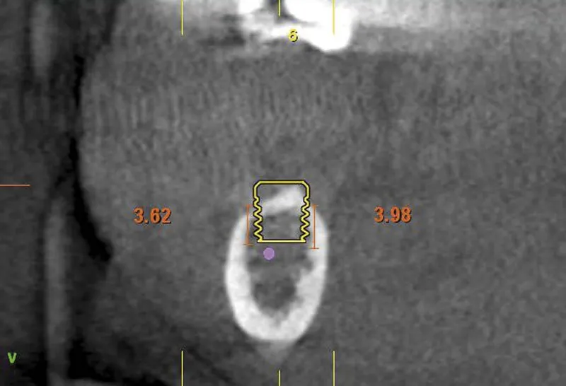 oxy implant espana