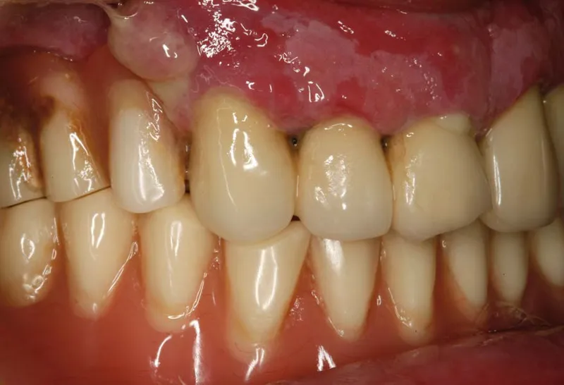 periodontitis tratamiento casero