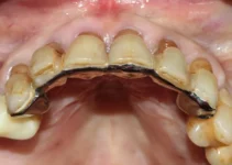 Puente dental de 4 piezas: características y ventajas