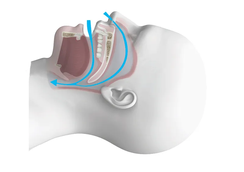 taquipnea definicion