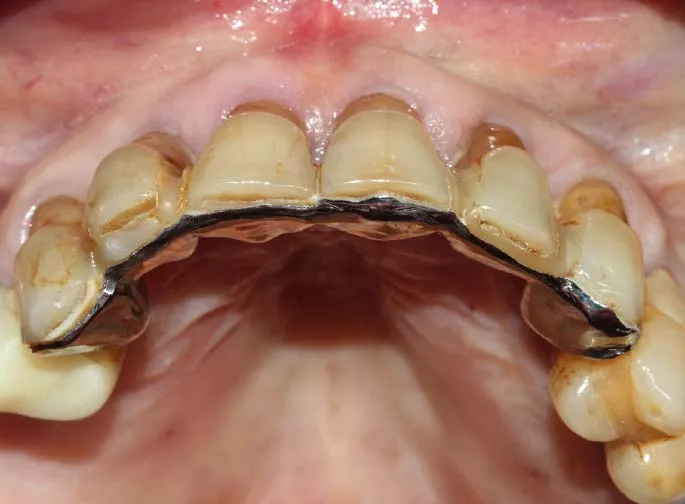 tipos de puentes dentales