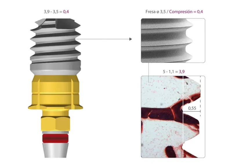 toma de medidas sobre implantes